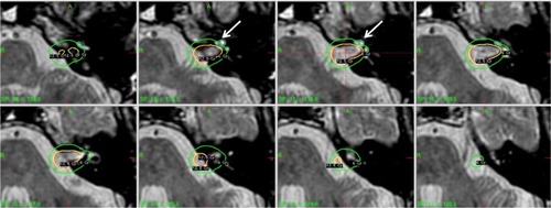 Figure 3 Illustration of dose distribution for SRS of a left-side VS case with the goal of minimizing the dose to the cochlea whose location is indicated by the arrow.Abbreviations: SRS, stereotactic radiosurgery; VS, vestibular schwannoma.