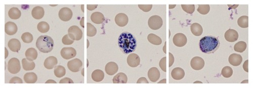 Figure 1 Microscopic findings of the growing stages of Plasmodium species in erythrocytes, which are known to be the merozoite, trophozoite, schizont, and gametocyte stages. Ring forms of two early trophozoites can be observed in an enlarged erythrocyte (left). The presence of more than 16 merozoites in a mature schizont suggests P. vivax infection (center). The presence of a round gametocyte in an enlarged erythrocyte also suggests P. vivax infection (right).