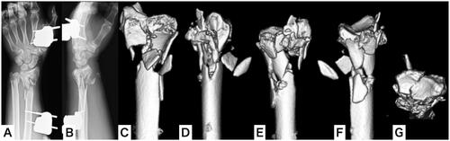 Figure 2. Plain x-ray and three-dimensional computed tomography (3-D CT) of the left wrist after external fixation as a first-line treatment. (A,B) Plain x-ray of the left wrist; (C–G) 3-D CT of the left wrist.