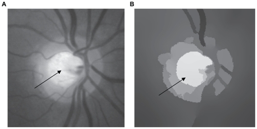 Figure 5 (A) Original image and (B) segmentation using our unsupervised strategy. The arrow indicates the isolated lesion.