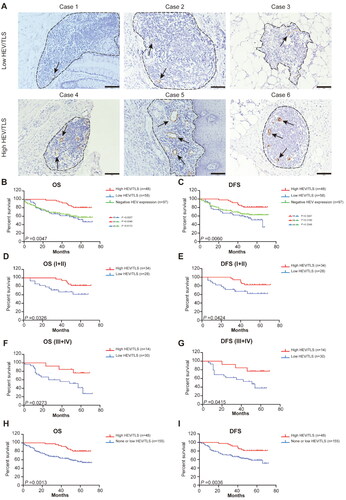 Figure 2. Characterization of different HEV/TLS and the patient survival outcomes. (A) Representative images of immunohistochemistry staining CRC tissues showing the different HEV/TLS (black arrowheads represent the HEV, black dotted lines are TLS, the top row is low HEV/TLS and the bottom row is high HEV/TLS). The solid black line indicates the scale bar, 100 mm. (B–C) Kaplan-Meier curves were used for comparison of OS and RFS in the CRC patient among three groups (High HEV/TLS vs. Low HEV/TLS vs. negative HEV expression). Significance was tested by log-rank test. (D–G) Kaplan-Meier curves for OS and RFS in different stage CRC patients with high HEV/TLS or low HEV/TLS. Significance was tested by log-rank test. (H–I) Kaplan-Meier curves for OS and RFS in CRC patients in the different group (High HEV/TLS vs. None or Low HEV/TLS). OS: overall survival; DFS: disease-free survival; HEV: high endothelial venules.