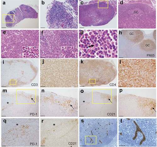 Figure 2. Histopathology of enlarged RHOA p.Gly17Val transgenic lymph nodes. (a, b) A lymph node from wild type mouse shows lymphoid aggregates in the cortex without germinal centers. The boxed region in A is shown in an enlarged form in B. (c, d). A lymph node from mutant mouse shows mixed cortical and paracortical hyperplasia with lymphoid follicles with germinal centers (GC). The boxed region in C is shown in an enlarged form in D. (e) The medullary area of lymph node is infiltrated by numerous plasma cells with readily recognizable morphology (see the higher magnification inset; also see supplementary material, Figure S2). (f, g) Occasionally, neutrophil infiltration (F and inset) and immunoblasts (G and arrow) are noted. (h-l) Immunoarchitecture of lymph node is shown by PAX5 (h), CD3 (i, j) and CD4 (k, l) staining. The boxed regions in I and K are shown in enlarged forms in J and L, respectively. (m–r) Sections from transgenic lymph nodes were also stained for PD-1 (m, n, q) and CD21 (o, p, r). The boxed regions in M and O are shown in enlarged forms in N and P, respectively. The region with asterisks in M and O are shown in enlarged forms in Q and R, respectively. Germinal center (arrow) is highlighted by nodular aggregates of CD21+ cells with dendritic pattern (o, p). PD-1+ cells are frequently observed in interfollicular area as well as within germinal center (m, n, q). Of note, CD21+ cells are also observed in extra-germinal center area (asterisks; O, R), where PD-1+ cells are also present (asterisks; M, Q). (s, t) Sections from transgenic lymph nodes are stained with MECA79 antibody specific for HEV. The boxed region in S is shown in enlarged forms in T. Scale bars represent: 10 μm for G; 50 μm B, E, F, J, L, Q, R, and T; 100 μm for D, H, N, and P.; 200 μm for A, M, O, and S; 500 μm for C, I and K.