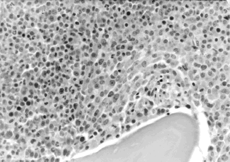 Figure 1. Bone marrow biopsy showed hypercellular marrow with 95–100% cellularity. The myeloid to erythroid ratio is markedly increased.