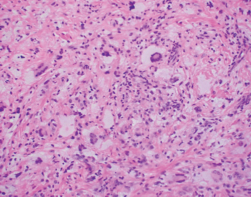 Figure 3. Photomicrograph demonstrating a Touton giant cell showing nuclei forming a wreath around a central spherule of pink cytoplasm (“blueberries stuck on a pink cheese ball”). Abundant pale “foamy” cytoplasm surrounds the wreath of nuclei (H&E x 400).