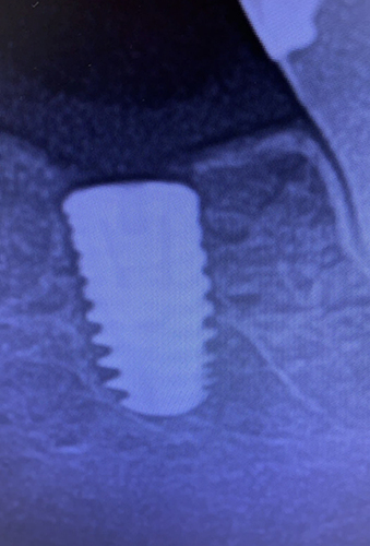 Figure 2 X-Ray of a BMDJ of an implantation site.