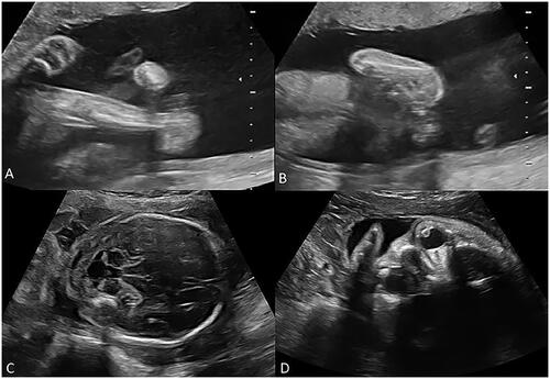 Figure 5. The ultrasound images of associated malformations in CVT fetuses. (A) The image shows arthrogryposis multiplex congenita. The lower limbs of the fetus were crossed, and the knee joints were stiff and cannot be bent. (B) The image shows hooks (ulnar radius dysplasia). (C) The image shows Dandy–Walker syndrome. (D) The image shows a congenital cataract.