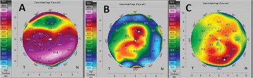 Figure 2 Scheimpflug-based corneal topography of the right eye (OD). (A) Preoperatively, demonstrating PMD pattern with inferior steepening associated with thinning and irregular astigmatism on the anterior sagittal map. (B) Four days following combined corneal wedge resection and corneal cross-linking, showing regularization of the topographic pattern. (C) Eight months postoperatively, depicting a stable regularized anterior pattern with mild inferior steepening and a thinnest pachymetry of 452μm.