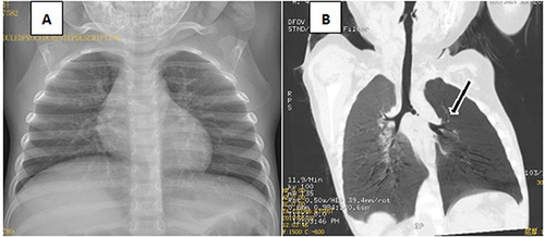 Figure 3 2-year-old boy presented with history of recurrent cough. The chest X-ray and chest fluoroscopy done showed no abnormality. After 26 days of symptomatic treatment, the recurrent cough did not improve and a chest CT scan with airway reconstruction was performed, suggesting a foreign body in the left main bronchus. One piece of crushed pea was removed from the left bronchus intra-operatively.
