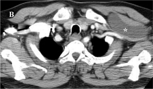 (B) Computed tomogram with contrast enhancement of the chest. A well-defined homogenous cystic mass is located underneath the pectoralis minor muscle and is attaching to the chest wall. This also showed that the ipsilateral subclavian vessels were compressed by the cystic mass.