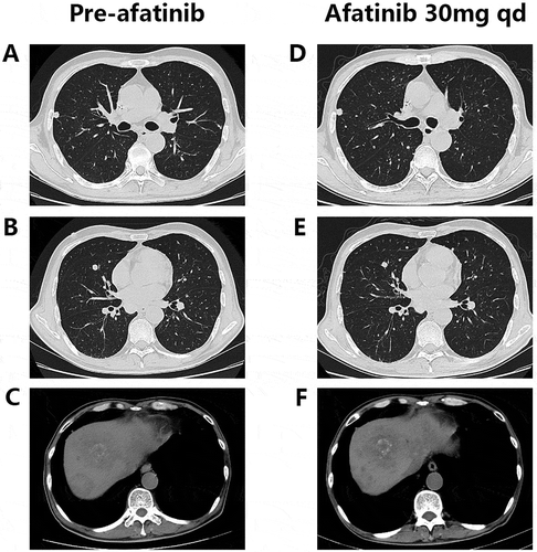 Figure 3. Chest and abdominal computed tomography (CT) scans prior to (A-C) and during (D-F) afatinib treatment.