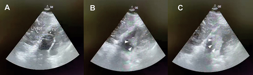 Figure 3 Focused echocardiography of the right atrium during a bubble test (subcostal 4-chamber view). (A) Focus on the right atrium with visualization of the terminal part of the guidewire (arrow). The dotted line indicates the out-of-plane part of the guidewire leading toward the ostium of the coronary sinus on the interatrial septum (asterisk) prior to the agitated saline injection; (B) Visual confirmation of early bubble entrance into the right atrium (arrowheads); (C) Late phase of bubble entry into the right atrium (arrowheads).