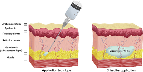 Figure 2 The application technique for collagen biostimulators or fillers and the skin after it.