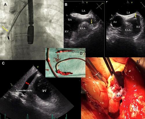 Figure 2 Transvenous extraction of an atrial lead was complicated by right atrial appendage rupture and cardiac tamponade requiring urgent cardiac repair. (A) Fluoroscopy. Atrial lead removal, the tip of the sheath marked with an arrow. (B) 2D TEE images (mid-esophageal view). The winding and pulling on the right atrial appendage (RAA) during extraction of the atrial lead. These potentially harmful effects are not visible on fluoroscopy. The sheath marked with an arrow. (C) 2D TEE images (transgastric view). Separation of pericardial layers – blood – immediately after removal of the lead. (D) Extracted leads on the table. Thick fibrotic encapsulation, partly calcified around the leads. Small abrasion of the external tube with perforation of the atrial lead – less visible. Fluid in the lead in this area. (E) Intraoperative view – RAA rupture/injury.