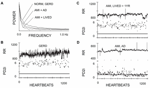 Figure 1 Power spectra, R-R intervals, and associated PD2is of three representative patients. A) The power apectra of the edited heartbeats (N-N) is shown for a normal patient with gastroesophageal reflex disorder (GERD), a patient with an acute myocardial infarction (AMI) who lived for at least the one year of follow-up (LIVED) and a patient with a matched AMI who died of arrhythmic death (AD) after discharge. B) The R-Rs (unedited) and the corresponding PD2is of the GERD patient. C) The R-Rs (unedited) and corresponding PD2is of the AMI, LIVED patient. D) The R-Rs (unedited) and corresponding PD2is of the AMI, AD patient.