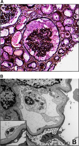 Figure 1 HIV-associated nephropathy.