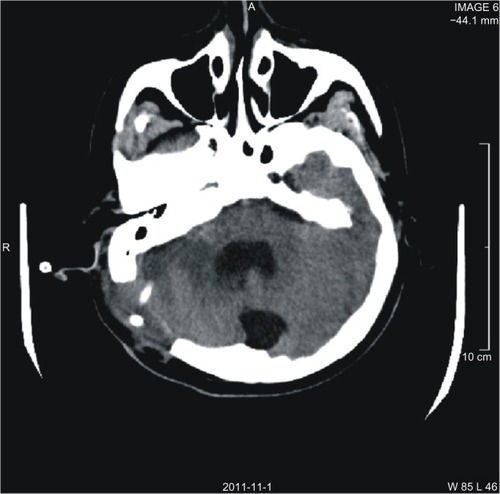 Figure 1 Image after second surgery. Head CT axial image shows the drainage tube placed in the lesion.