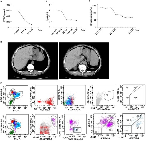 Figure 2. Clinical manifestation and laboratory examinations of the patient after four cycles of anti-B treatment. (A) Serum VEGF level of the patient decreased significantly after treatment. (B) IgA level in plasma of the patient decreased significantly after treatment. (C) Creatinine level of the patient returned to normal after treatment. (D) Computed tomography scans revealed ascites disappeared after treatment. (E) Flow cytometry showed no monoclonal B cells after four cycles of anti-B treatment.