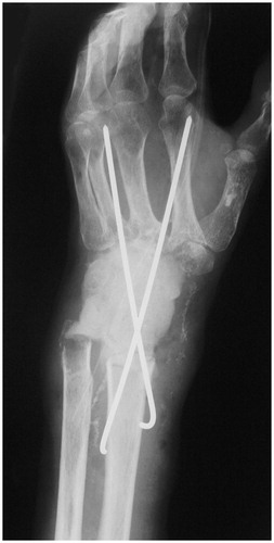 Figure 3. Radiograph after the radical debridement. The wrist was stabilised with two crossed Kirchner wires, and bone cement block including streptomycin sulphate was put in the dead space.