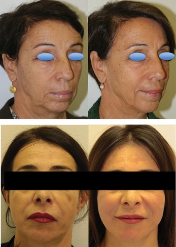Figure 5 Representative pictures of two patients obtained before and 12 months after the last of three treatments performed at 3-month intervals. Patients provided written informed consent for the use of the images for scientific research.