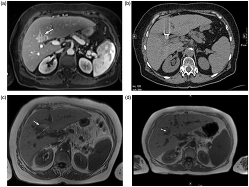 Figure 1. Transverse images of a 75-year-old woman with liver metastasis of colorectal cancer origin treated with low-frequency microwave ablation (LF-MWA). (a) MR image (T1 weighted) obtained 2 weeks before MWA shows a single metastasis (arrow) in segment 4 with a maximum diameter of 31.5 mm and a volume of 10.39 mL. (b) Computed tomography (CT) image obtained during MWA (30 min, 45 W). (c) MR image (T1 weighted) obtained 24 h after successful treatment shows typical coagulation (volume: 20.23 mL, max. diameter: 44.3 mm). (d) MR image obtained 48 months (volume: 5.11 mL) after MWA shows area of scarring in the ablation zone with no progress in size.