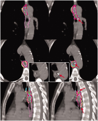 Figure 1. Delineations of patient 5 on the planning computed tomography without (left) and with markers (right). The delineations of the individual observers are indicated in different colors. The colors match the same observer throughout this work. Red arrows indicate fiducial markers. Insert demonstrates transversal slice without delineations.