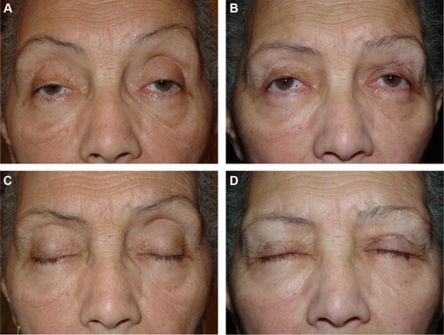 Figure 5 Preoperative and postoperative appearance of a 61-year-old female patient.