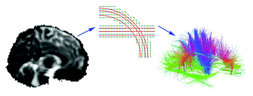 Figure 1. Diffusion tensor imaging and tract tracing. In whole brain tractography, diffusion weighted images (left panel) show the diffusion of water in specific directions (94 directions in the current study). A diffusion function (middle panel) can be reconstructed based on the sampling of diffusion in each direction, to identify axons and major tracts, as water tends to diffuse preferentially along tracts. Tract tracing algorithms can assemble the data into curves and bundles based on diffusion properties. In a three-dimensional map of the recovered fibers (right panel), a color code indicates the fiber directions. These fibers may be grouped into bundles and their integrity and connectivity can be evaluated. This image is adapted from ref. Citation29.