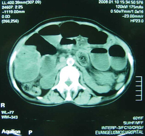 Figure 1. Abdominal computed tomography scan. Enlarged small bowel loop caused by obstruction. No peritoneal thickening was demonstrated.