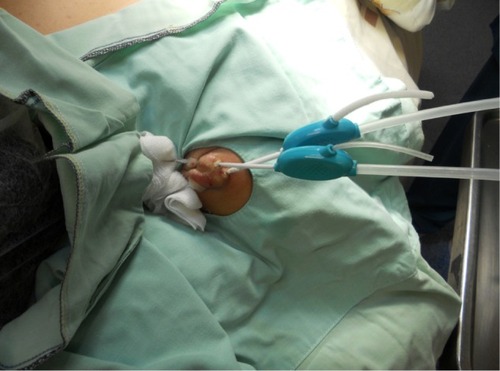 Figure 3 With intralesional cryotherapy, a specially designed cryoneedle is inserted (under translesional local anesthesia) into the long axis and mid height of the respective keloid.