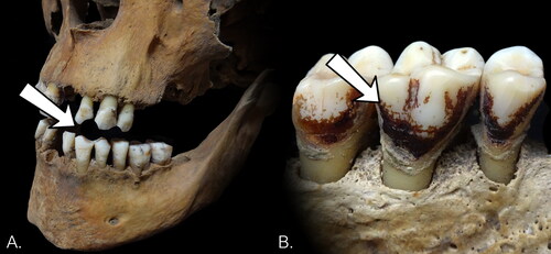 FIG. 2 Examples of evidence for tobacco consumption considered in this study: (A) pipe notch, (B) dental staining on lingual surfaces. Photographs by M. Casna.