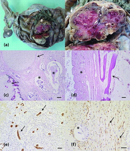 Figure 1. Ovarian teratoma in an equine fetus. (a) The right ovary shows a solid mass (hash) within a cystic structure. The left ovary is observed and exhibits a blackened appearance (asterisk). (b) Magnification from Figure 1 (a). A solid mass reveals a whitish to reddish lobulated cut surface. (c) Neoplastic tissue contains well-differentiated tubular arrangements of neoplastic epithelial cells (asterisk) and cartilaginous matrix (arrow). H&E staining is shown, and the scale bar represents 100 μm. (d) Other components of the neoplasm were pavimentous stratified keratinizing epithelium, pilous follicles (asterisk) and osseous matrix (arrow). H&E staining is shown at 100x magnification. (e) Tubular arrangements of epithelial cells with cytoplasmic immunopositivity for cytokeratin (arrow). Peroxidase system (Advance HRP Enzyme, DakoCytomation, Carpinteria, CA, USA). The cells were stained with the anti-cytokeratin AE1AE3 primary antibody and counterstained with Harris’ hematoxylin. The scale bar represents 50 μm. (f) Vimentin-positive neoplastic mesenchymal cells (arrow). Negativity for vimentin can be observed in neoplastic epithelial cells (asterisk). Peroxidase system (Advance HRP Enzyme, DakoCytomation, Carpinteria, CA, USA). The cells were stained with an anti-vimentin primary antibody and counterstained with Harris' hematoxylin. The scale bar represents 30 μm.