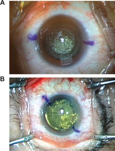 Figure 1 Fragmentation pattern during cataract surgery (A) Complete pattern and (B) Quadrant pattern.