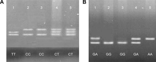 Figure 1 PARP-1 C410T polymorphism (A) and G1672A polymorphism (B).Notes: (A) Sample 1 shows TT genotype, samples 2 and 3 show CC genotype and samples 4 and 5 show CT genotype of PARP-1 C410T. (B) Samples 1 and 4 show GA genotype, samples 2 and 3 show GG genotype and sample 5 shows AA genotype of PARP-1 G1672A. Patient-related data were masked in the figure.Abbreviation: PARP-1, poly (ADP-ribose) polymerase-1.