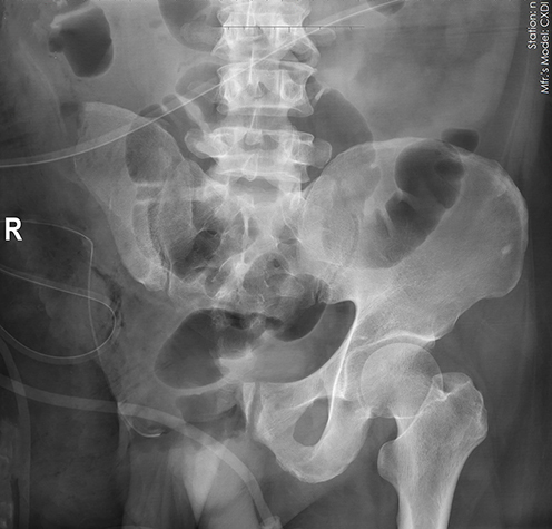 Figure 4 Radiographic image after hemipelvic resection.