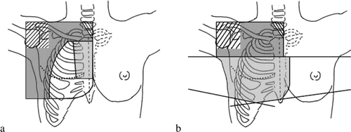 Figure 1.  The two treatment techniques with the field borders shown in black. a. 3F: The dark grey area shows the photon field, the light grey area the IMN electron field and the white area the chest wall electron field. b. PWT: The dark grey area shows the periclavicular-axillary photon field whereas the light grey area shows the tangential photon fields.