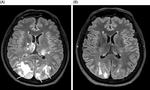 Figure 1. Brain magnetic resonance imaging (MRI) using fluid-attenuated inversion recovery (FLAIR). (A) MRI on admission showing posterior reversible encephalopathy syndrome (PRES, arrows) and bilateral thalamic haemorrhage (arrowheads); (B) MRI at day 17 showing improvement of PRES and thalamic haemorrhage.