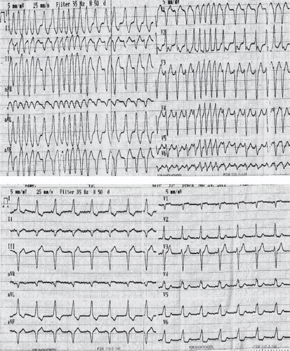 Fig. 1. Top. ECG showing irregular, rapid ventricular rate (rate 172) with wide QRS complexes and tachycardia. Bottom. ECG obtained 30 min after admission revealed WPWS including shortened PR interval, slurring, slow rise of the QRS complex (delta wave), and widening of the QRS complex.