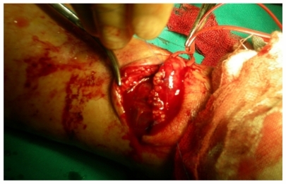 Figure 5 Anastomosis vesicle was sutured over and over with 4-0 prolene.