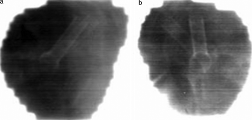 Figure 7.  Images recorded with an electronic portal imaging device from two different patients. Timeframe for recording each image is approximately 1–2 s. Both images are seen to have a double image of the stent. This could only have been obtained if the stent has moved within the timeframe of recording the image.