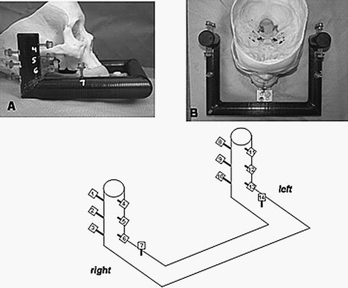 Figure 1. The EarMark™ system as arranged for a patient's radiographic studies (i.e., CT scanning). At top left is a side view, with an overhead view at top right. The EarMark™ is composed of carbon fiber. It is coupled to the LADS (which has the appearance of a mouthguard) via a customized block epoxied to the EarMark™, allowing a screw-fit to the LADS. At bottom is the numbering scheme for the fiducial markers. These numbers are used in data reporting in Tables II, IV, and VI.