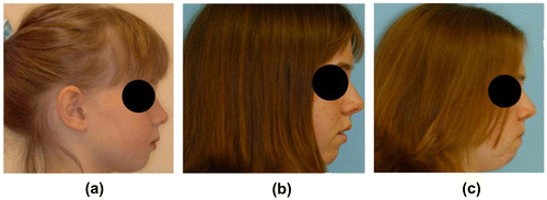 Figure 4 This little girl’s face grew more vertically (less forward) due to poor rest oral posture.