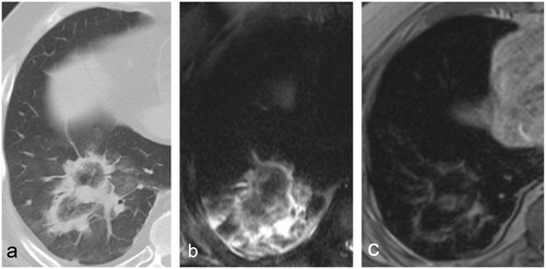 Figure 3. Typical 24-h post-MWA aspect of a colorectal cancer metastasis in a 60-year-old patient on (a) CT, (b) T2 and (c) ceT1. The treated tumour is clearly visible within the ablation zone both on CT and ceT1 images but not on T2. In this case, the tumour appears in direct contact with the peripheral rim on CT, but a wider safety rim can be noticed on ceT1. No local tumour progression was recorded.