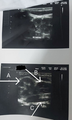 Figure 4 Abdominopelvic ultrasound showing left side supernumerary kidneys and right side single normal kidney ((A): left kidney (B): left supernumerary kidney lying on psoas muscle (C): left psoas muscle).