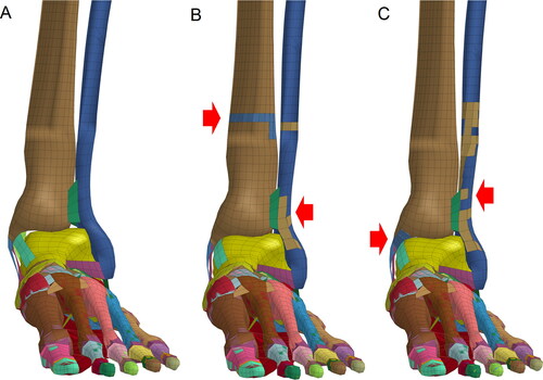 Figure 9. Ankle fractures caused by lateral-medial (L-M) impacts on the lower leg. (A) Impact at a speed of 10 m/s did not cause ankle fractures. (B) Impact at 15 m/s caused fractures of the lateral condyle and impact site. (C) Impact at 20 m/s caused fractures of the lower fibula and avulsion fractures of the medial condyle. (Red arrow indicates the fracture site where elements are coloured differently from the surrounding area).