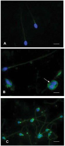 Figure 4. Immunofluorescence staining of spermatozoa using an anti8-iso-PGF2α polyclonal antibody and 4,6‐Diamidino‐2‐phenylindole (DAPI) solution. (A) sperm from an idiopathic infertile patient show a weak label of anti8-iso-PGF2α in the sperm tail, the signal appears more evident at the level of the mitochondrial sheath. The nuclei are staining with DAPI. In (B), showing spermatozoa from an infertile varicocele patient, the anti8-iso-PGF2α staining is located in the tail and in presence of cytoplasmic droplets (arrow). The nuclei stained with DAPI are altered. In (C), spermatozoa of a globozoospermic patient are shown; the nuclei appear perfectly round as evidentiated by DAPI, the anti8-iso-PGF2α fluorescent label is strongly evident in the tails, sometimes coiled, and in the abundant cytoplasmic residues surrounding the round heads. A, B: bar 5 µm, C: bar 7 µm.