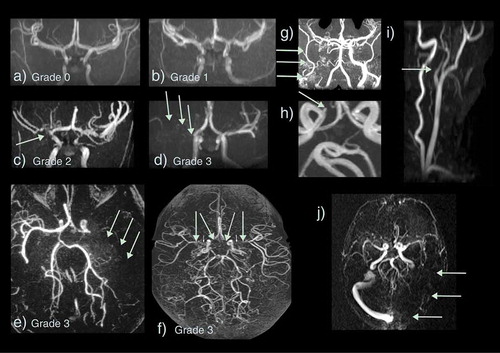 Figure 5. Vasculopathy on magnetic resonance angiography and venography (MRA/V) in sickle cell disease. Arteriopathy is graded as (a) 0 – none, (b) 1 – minor signal attenuation, (c) 2 – obvious signal attenuation but presence of distal flow, (d) 3 – signal loss with and without collaterals i.e. occlusion (e) Grade 3 – occluded left middle cerebral artery (MCA) (green arrows) with basal ganglia and posterior pial collaterals (f) Grade 3 – bilateral occluded terminal internal carotid arteries (ICA) and proximal MCAs with basal ganglia and pial collaterals visible (g) Grade 3 – occluded proximal right ICA with external ICA (green arrows) and skull base collaterals (h) Small aneurysm of the right cavernous ICA (green arrow) (i) Dissection of the origin of the left common carotid artery showing a typical string sign (green arrow) (j) Occluded left transverse and sigmoid sinus on MRV