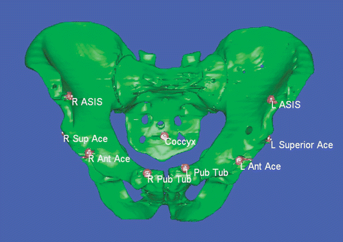 Figure 3. Anthropometric analysis view generated in Mimics software package with screw heads segmented in red and pelvis segmented in green. [Color version available online.]