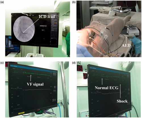 Figure 5. The pictures of (a) ICD lead on coronary fluoroscopy, (b) the pig with electrodes, (c) ventricular fibrillation signal, and (d) electric shock/recovered ECG.