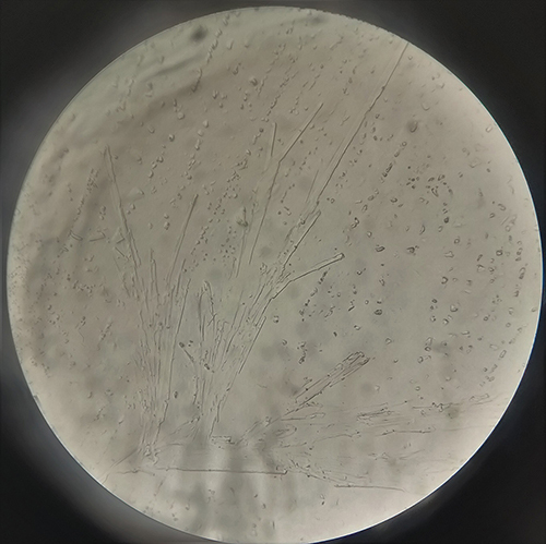 Figure 3 Microscopic examination of KOH wet mount corneal scrapping (X10) showing fungal filaments.