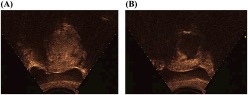 Figure 1. Preoperative and postoperative CEUS images. (A) CEUS image of diffused adenomyosis before HIFU treatment. The myometrium of the posterior uterine wall with abundant vascular supply was thicker than the anterior uterine wall. (B) CEUS image with a non-defused area in the lesion, which indicated that more than 85% of the lesion was ablated.